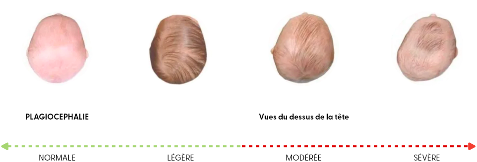 4tetes plagiocephalie